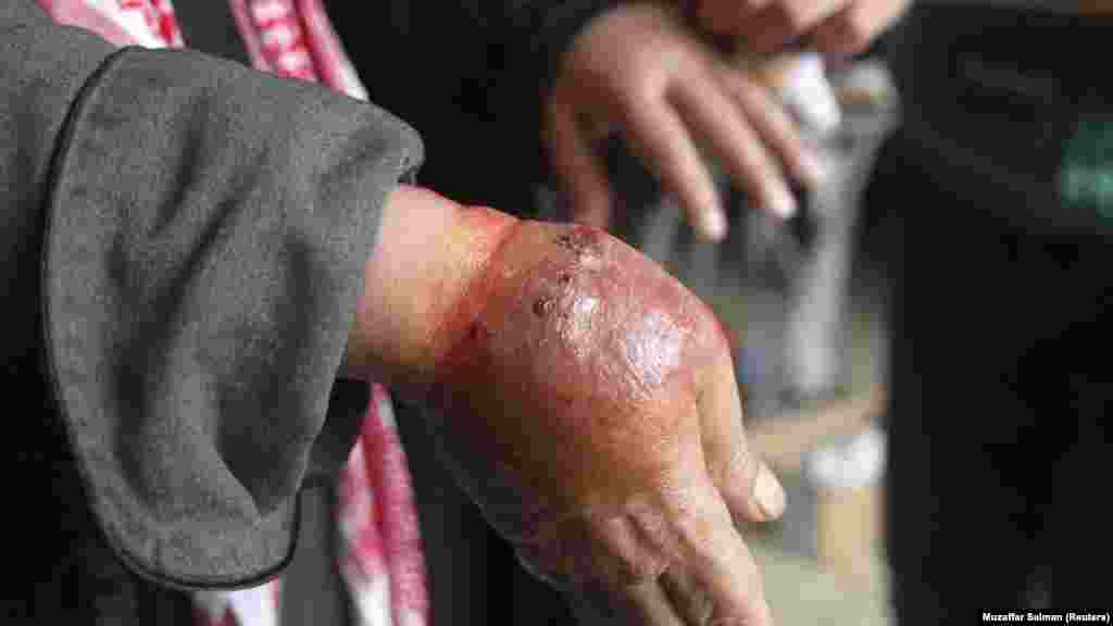 Un homme avec des mains présentant des symptômes de la leishmaniose, attend d&#39;être soigné dans un hôpital à Alep, le 11 Février 2013. (SYRIA - Tags: HEALTH CIVIL UNREST) - RTR3DN52 