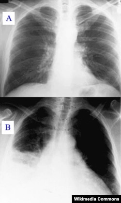X-ray showing clear (A) and pneumonia infected lungs (B)