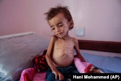 In this Oct. 1, 2018 file photo, a malnourished boy sits on a hospital bed at the Aslam Health Center, Hajjah, Yemen.