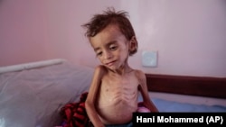 In this Oct. 1, 2018 file photo, a malnourished boy sits on a hospital bed at the Aslam Health Center, Hajjah, Yemen.
