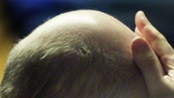 An example of male pattern baldness