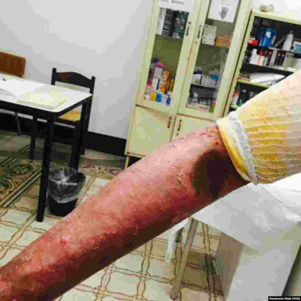 This man&#39;s arm was burned by smugglers. He was trying to reach Libya and then travel onward to Europe. (photo provided by a doctor in a Milan, Italy medical center)