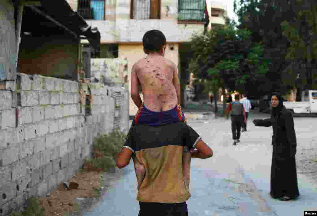 Seorang pria menggendong seorang anak laki-laki yang mengalami luka-luka di punggungnya akibat serangan udara pasukan Suriah di kota Arbin, pinggiran Damaskus.