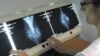ЖАХЛИВІ ЦИФРИ: щогодини від раку грудей в Україні помирає одна жінка - МОЗ 