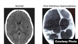 Hydrocephalus, or water on the brain, affects 100,000 children every year in Africa alone. (Credit: Schiff)