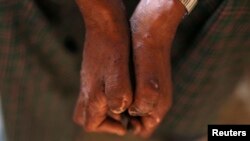 FILE - A patient shows the effects of leprosy on his hands in Myanchaung Leprosy Hospice, Halegu township, Yangon Division, Jan. 21, 2014. Southern Malawi has seen a resurgence of leprosy, which was believed to have been stamped out in the country in 1970.