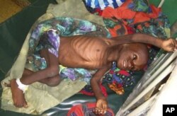 Abdirahman Arale, deux ans, hospitalisé pour malnutrition à Mogadiscio