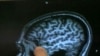 MRI-like Scan May Help Identify Alzheimer's