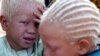 FILE - Albino twins are seen in Africa, March 29, 2005. 