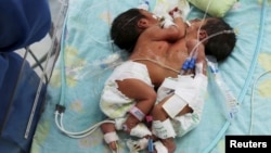 FILE - Conjoined twin girls, born in Peru in April 2015, are shown at three days old. Another set of conjoined twin girls was born in northern India Feb. 3, 2016. 