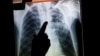 Bakteri TB Ditemukan pada Pasien yang Sudah Sembuh