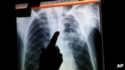 Phim X quang của một bệnh nhân bị ung thư phổi