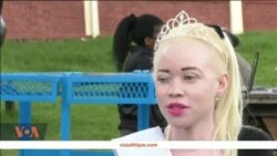 Moi Sitembiso, Miss Albinos!