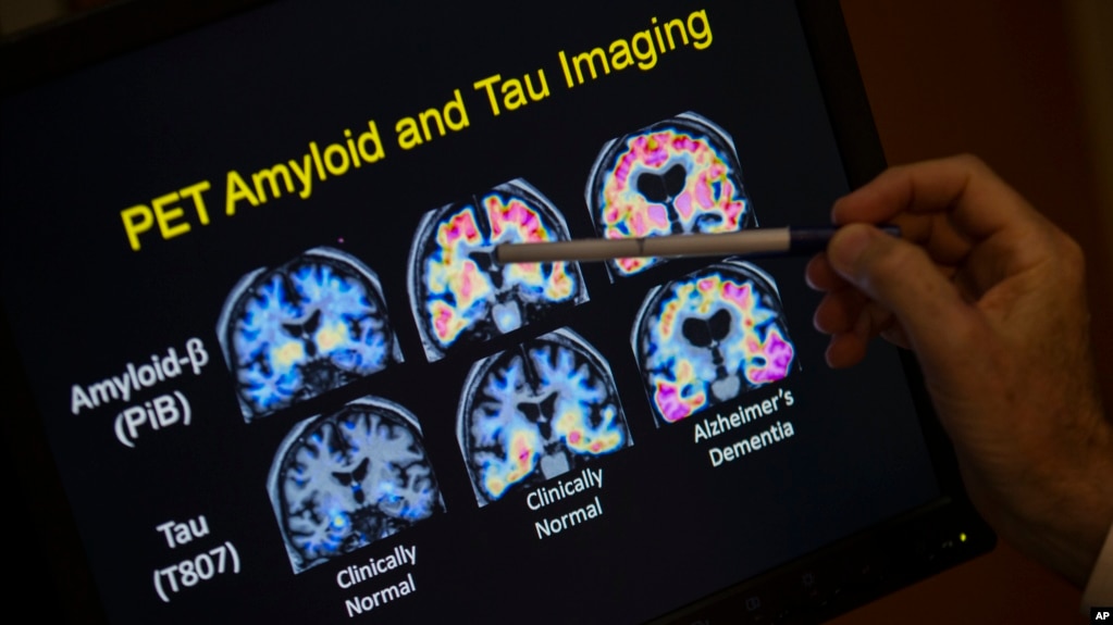 FILE - A doctor points to PET scan results that are part of a study on Alzheimer's disease at Georgetown University Hospital, on Tuesday, May 19, 2015, in Washington. (AP Photo/Evan Vucci, File)