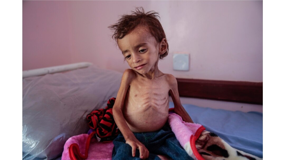 FILE -A malnourished boy sits on a hospital bed at the Aslam Health Center, Hajjah, Yemen, Oct. 1, 2018.