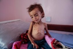 FILE -A malnourished boy sits on a hospital bed at the Aslam Health Center, Hajjah, Yemen, Oct. 1, 2018.