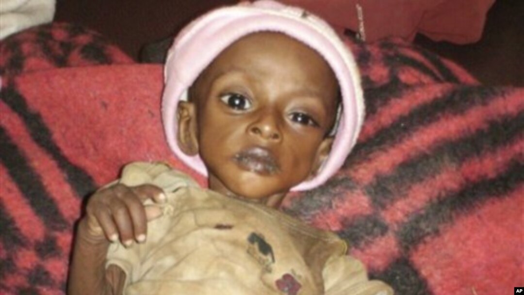 Ethiopian child Bizunesh Hidana 3-year-old weighing less than 10 pounds (four kilograms) is seen at an emergency feeding center in southern Ethiopia (File Photo).