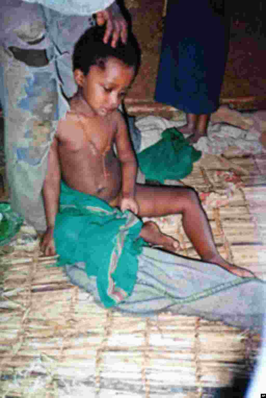 In a remote village in Ethiopia, this girl shows all of the signs of acute flaccid paralysis - the signal condition for polio.
