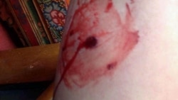 བྲག་མགོར་བོད་མི་གསུམ་ལ་མེ་མདའ་བརྒྱབས་ཏེ་བོད་མི་གཅིག་ལ་རྨས་སྐྱོན་བྱུང་ཡོད་པ།