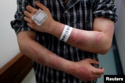 Calvin So, a victim of Sunday's Yuen Long attacks, shows his wounds at a hospital, in Hong Kong, China, July 22, 2019.