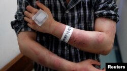 Calvin So, a victim of Sunday's Yuen Long attacks, shows his wounds at a hospital, in Hong Kong, China, July 22, 2019. 