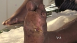 Fight Against Leprosy Continues: Case By Case