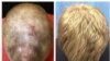 Hair growth on the patient's head is seen five months into treatment and eight months into treatment. (Yale University)