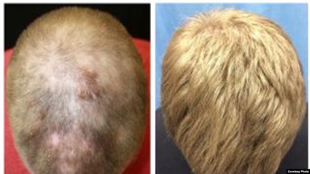 Se observa crecimiento de cabello en la cabeza del paciente a los cinco meses de tratamiento y a los ocho meses de tratamiento. (Universidad de Yale)