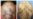 Arthritis Drug Spurs Hair Growth on Bald Man's Head