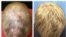 Hair growth on the patient's head is seen five months into treatment and eight months into treatment. (Yale University)