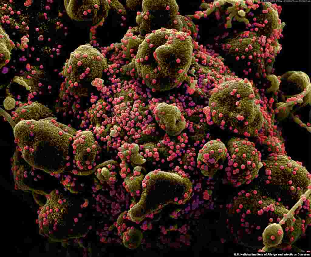 Detail of a human cell heavily infected by SARS-CoV-2. Once expelled from a patient&#39;s body, the virus is believed to survive for up to several days on some surfaces. (Courtesy: U.S. National Institute of Allergy and Infectious Diseases)