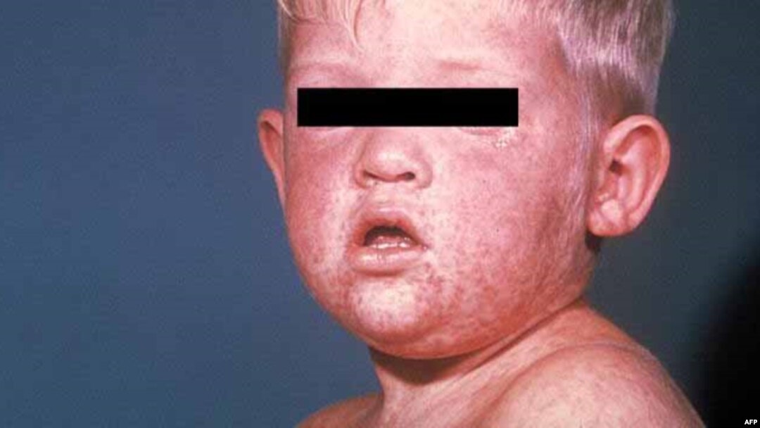 Bệnh sởi có thời gian ủ bệnh 21 ngày.