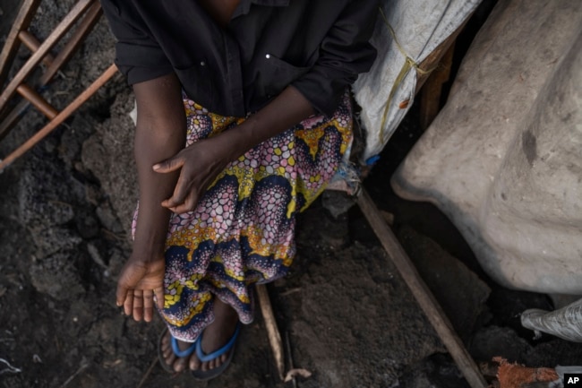 Sarah Bagheni, in the Bulengo refugee camp in Goma, Congo, suspects she may be infected with Mpox on Aug, 15, 2024. (AP Photo/Moses Sawasawa)