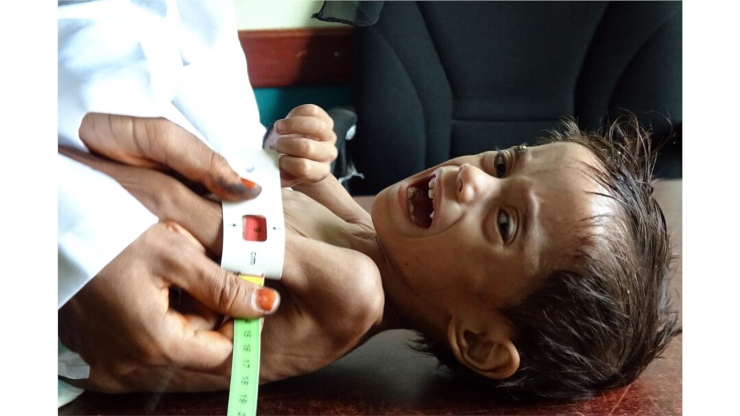 FILE - Ahmed Abdo Salem, a 2-year-old Yemeni child displaced by conflict and suffering from malnutrition (weighing only five kilograms), is measured at a health clinic in the war-ravaged western Hodeida province, Feb. 15, 2021.