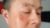 北京公民活跃人士李蔚被杭州警察打伤 （推特图片）