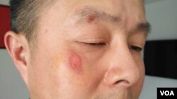 北京公民活跃人士李蔚被杭州警察打伤 （推特图片）