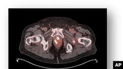 ARCHIVO -Imagen de una próstata con signos de cáncer. Los hombres latinos enfrentan tasas elevadas de cáncer de próstata en Estados Unidos, siendo la cuarta causa de muerte por cáncer en esta población. 