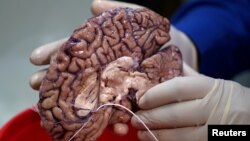 A doctor holds a human brain in a brain bank in the Bronx borough of New York City, New York, U.S. June 28, 2017. REUTERS/Carlo Allegri