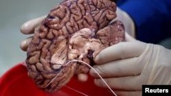 A doctor holds a human brain in a brain bank in the Bronx borough of New York City, New York, U.S. June 28, 2017. REUTERS/Carlo Allegri