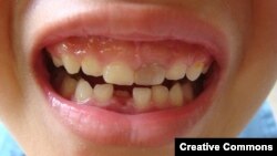 Chinese scientists have grown teeth from stem cells cultured from human urine.