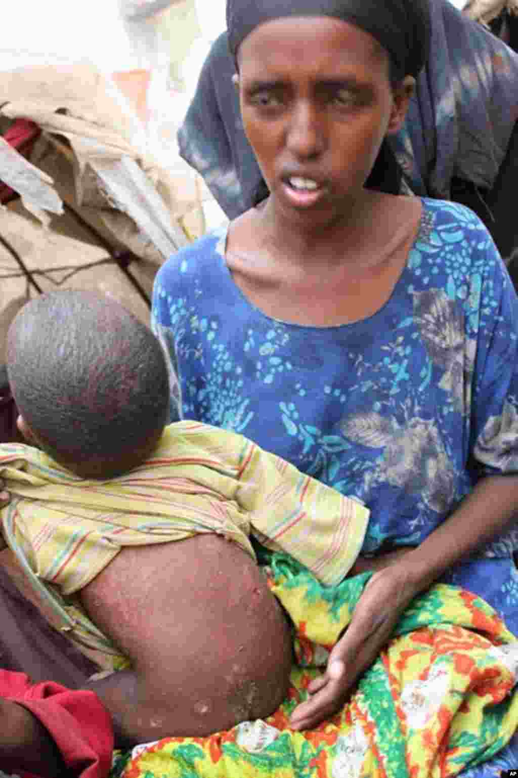 Arfon Abdi Hassan shows the measles scars on the back of her one-year old son. (VOA - P. Heinlein)