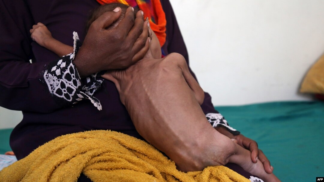 Seorang ibu menggendong bayinya yang mengalami malnutrisi akut di sebuah rumah sakit di Taez, Yaman (foto: dok). Konflik berkepanjangan di Yaman berdampak pada jutaan anak-anak di sana.