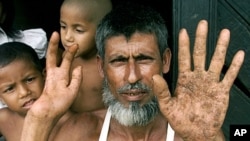 A Bangladeshi near Dhaka shows shows his arsenic-infected palms, Sept. 29, 2011 (file photo).