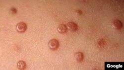 Molluscum Contagiosum