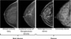 This image provided by the UW/Fred Hutch Cancer Center Breast Imaging in October 2024 shows mammogram scans with dense and not dense tissue. 