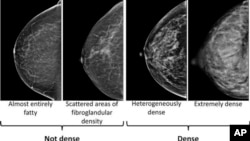 This image provided by the UW/Fred Hutch Cancer Center Breast Imaging in October 2024 shows mammogram scans with dense and not dense tissue. 