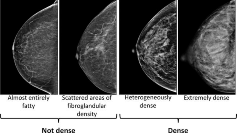 Dense breasts can make it harder to spot cancer on a mammogram