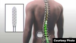 Researchers at the Mayo Clinic placed an electronic device near the injury to Chinnock's spinal cord. (Mayo Clinic)