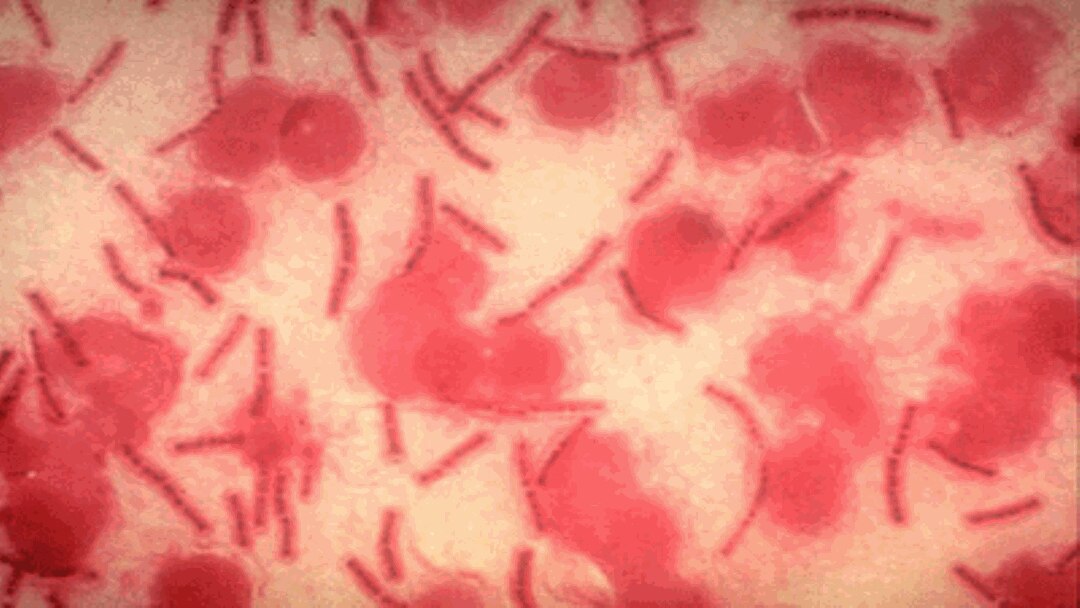 Anthrax merupakan penyakit menular akut dan sangat mematikan yang disebabkan bakteri Bacillus Anthracis.