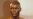 Study Links Early Baldness to Prostate Cancer in African Americans